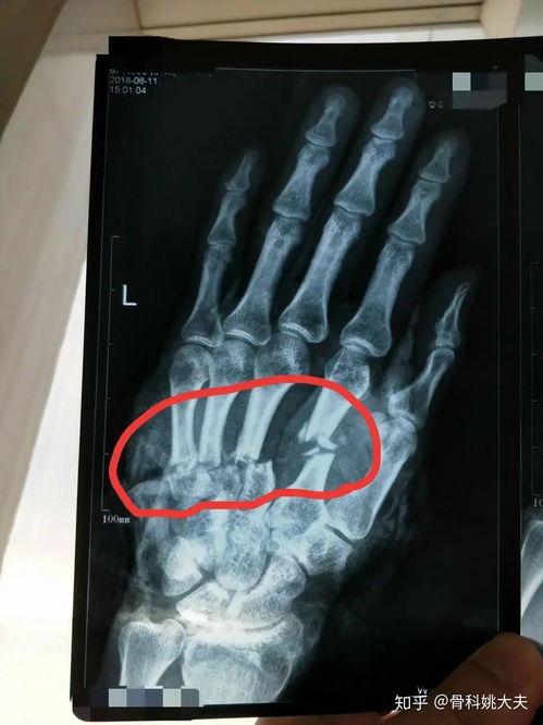 手骨骨折图片,影像学诊断与治疗策略